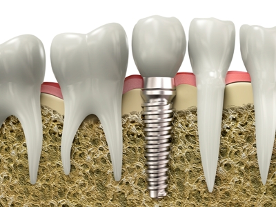 Desert-Dental-Specialists-photo-dental-implant-cross-section